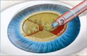 第2步:晶狀體乳化吸出