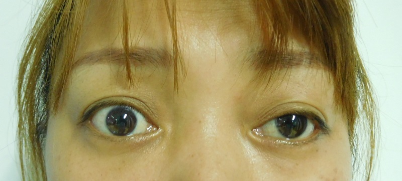 甲狀腺相關性眼病