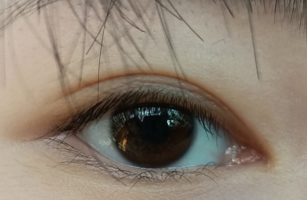 倒睫怎么辦？