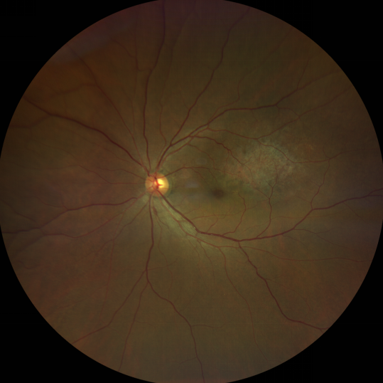 脈絡膜黑色素瘤治療