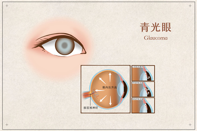 青光眼手術