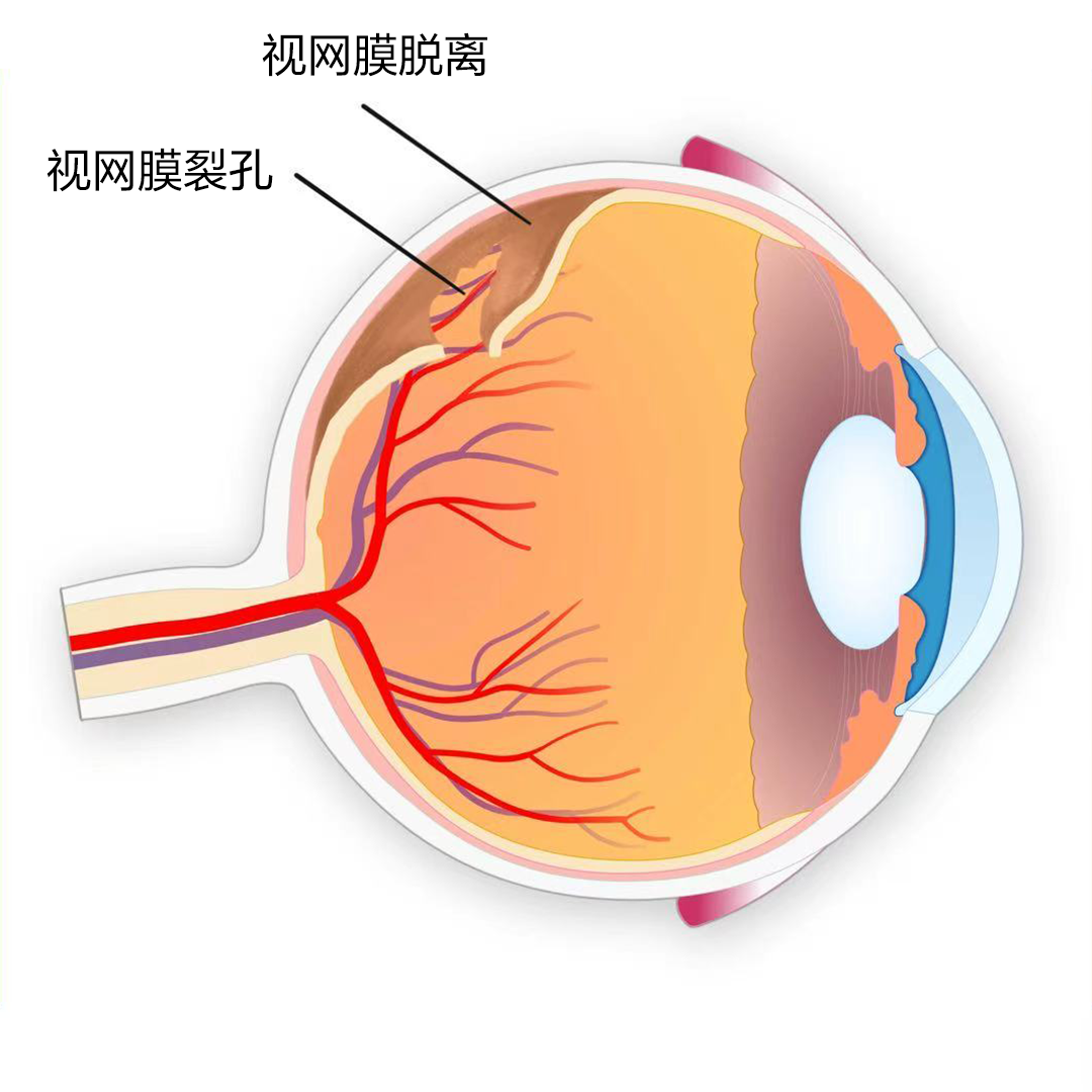 黃斑裂孔
